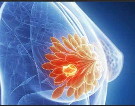 Novità importanti sulla lotta contro il tumore al seno. Al San Raffaele  si sta valutando un nuovo importante strumento diagnostico.