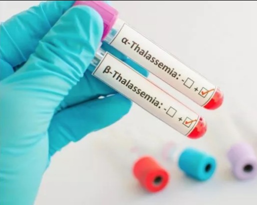 Beta Talassemia, con nuova cura il 50% dei pazienti dimezza il fabbisogno di sangue.