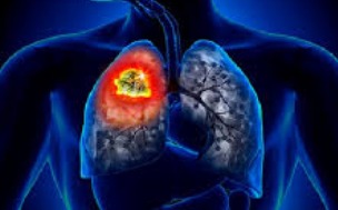 Tumore al polmone, parte il primo screening su oltre 7300 forti fumatori.