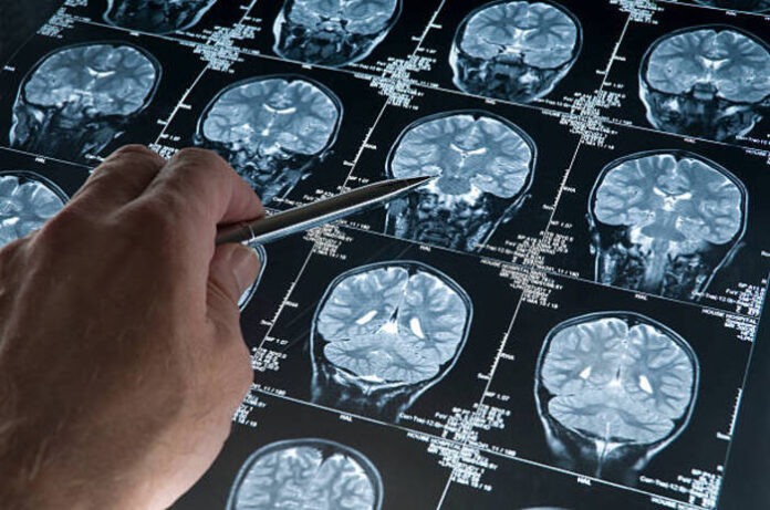 Referto_Glioblastoma