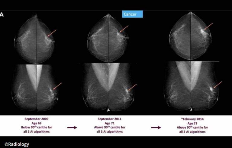 Tumore al seno, l’AI può intercettare i segnali del cancro da 3 a 6 anni prima della diagnosi.