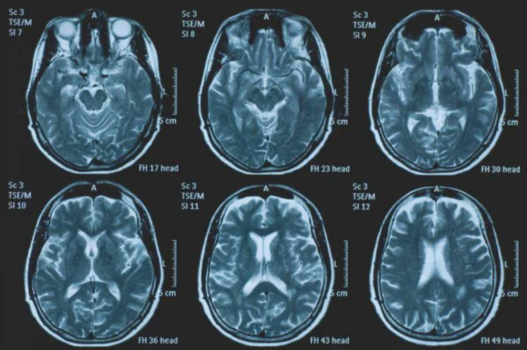 Una persona su 3 ha un disturbo neurologico, a Napoli arriva BrainSpace House.